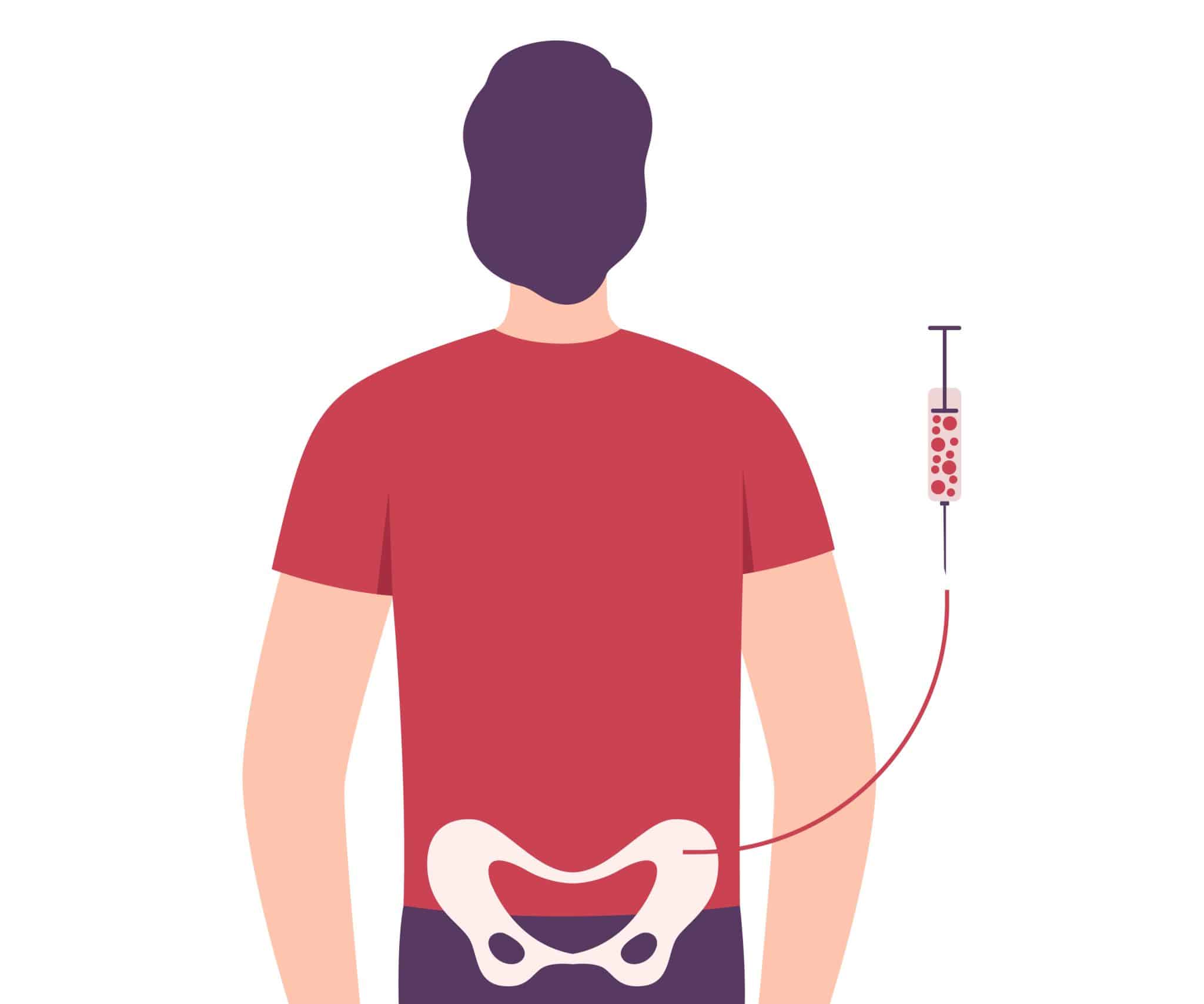 immagine illustrata con donatore di midollo osseo a cui viene prelevato il midollo