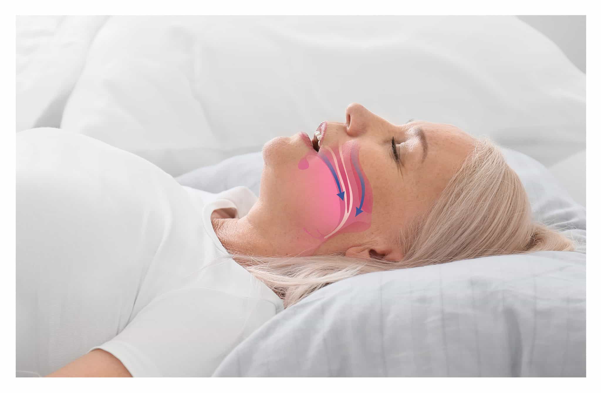 Illustrazione di come funziona apnea notturna ostruttiva su immagine di donna che dorme