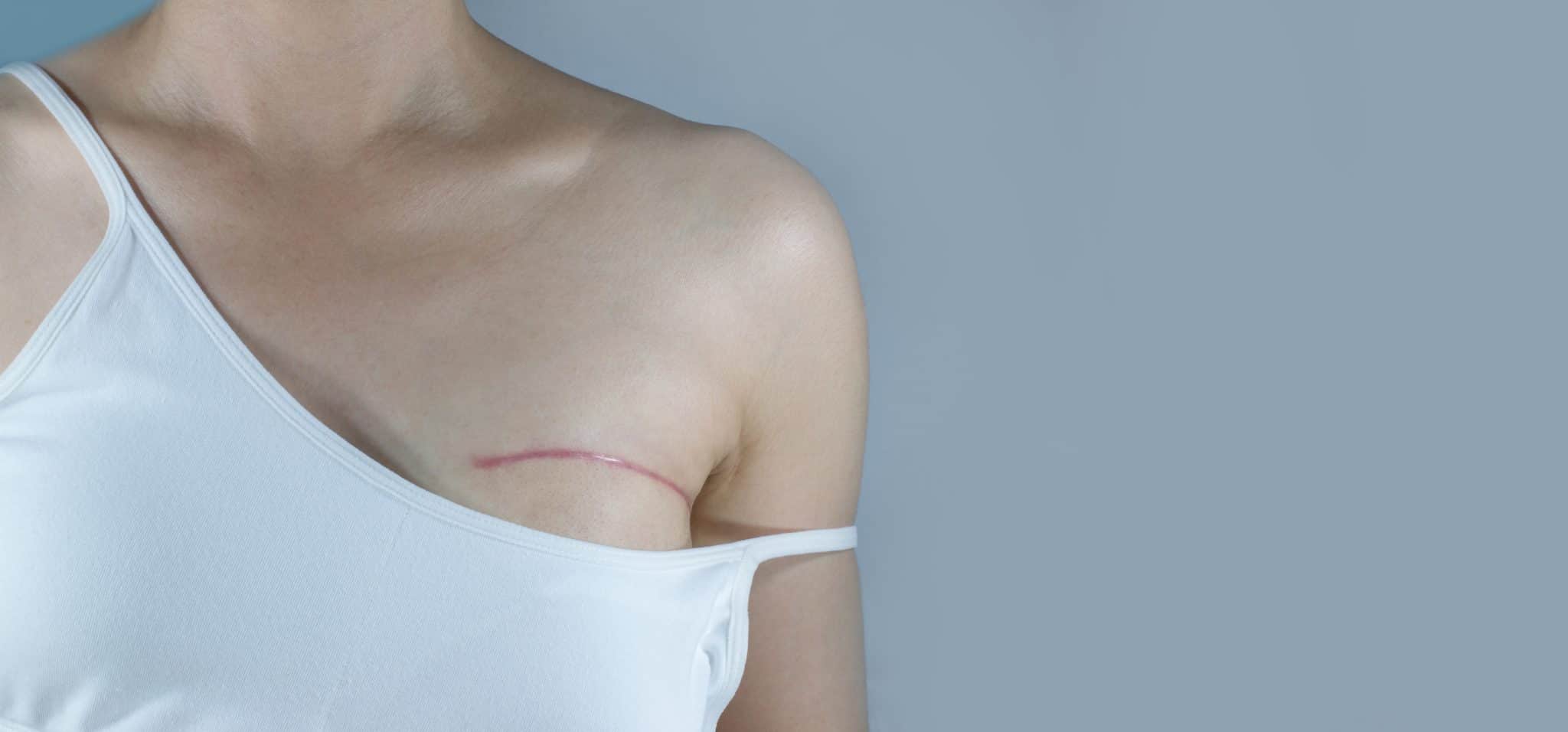 primo piano sul seno di una donna che ha subito mastectomia